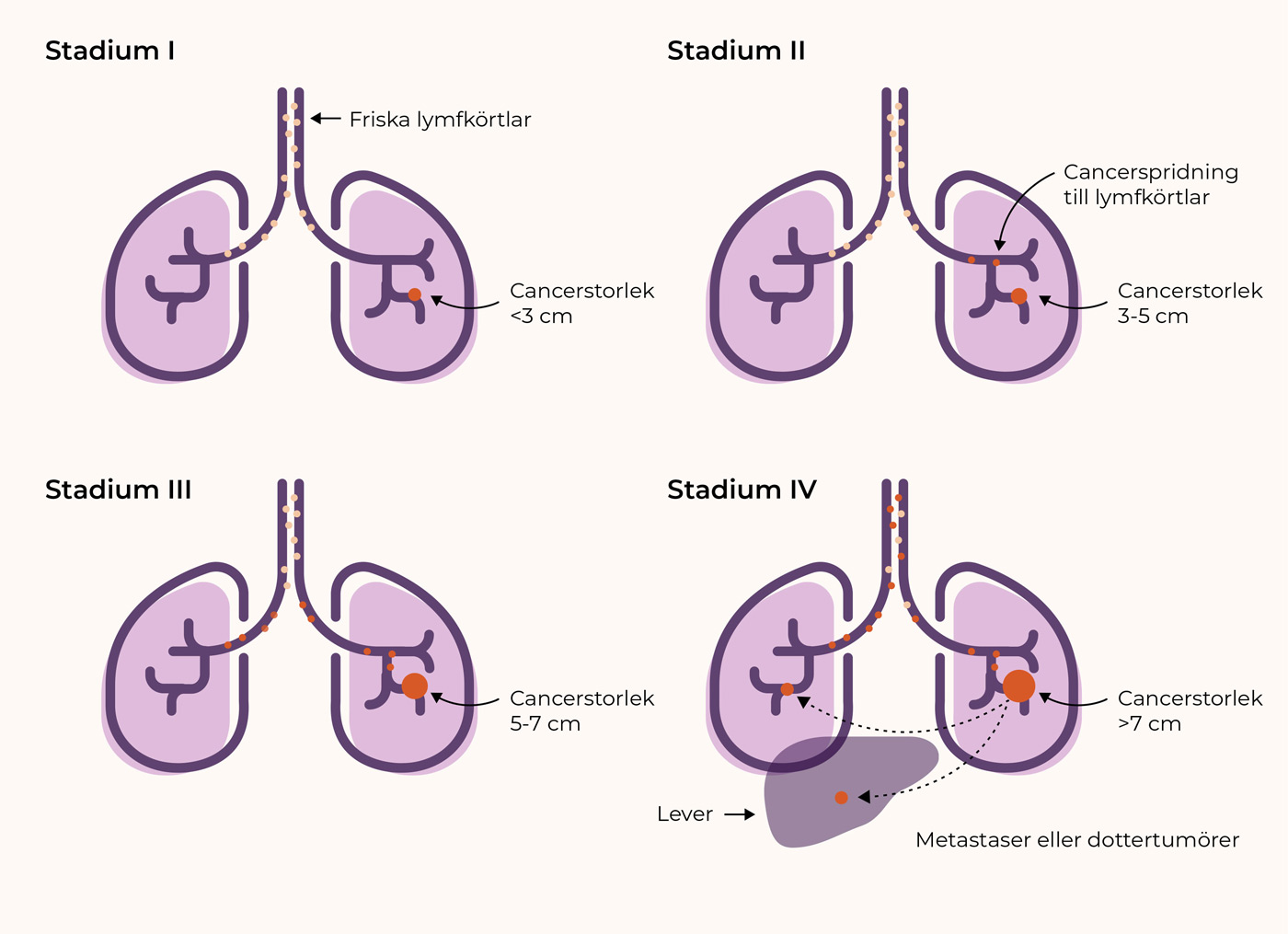 Grafik som visar lungcancer stadium